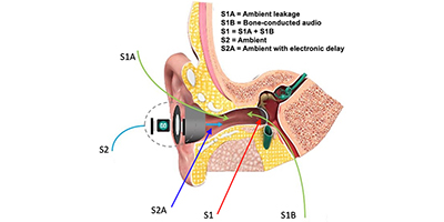 Cross Section of an ear canal with hearing aid device