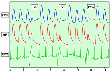 Image of PPG can detect unusual cardiac events such as premature ventricular contraction